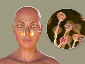 عفونت قارچی سینوس