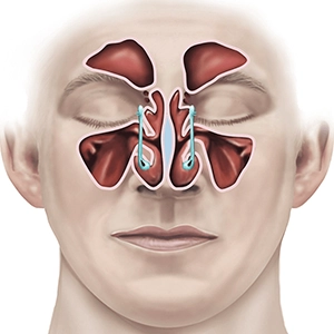 جراحی آندوسکوپی سینوس