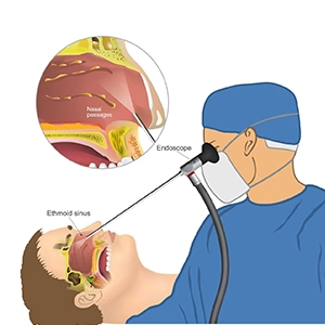 درمان پولیپ با آندوسکوپی