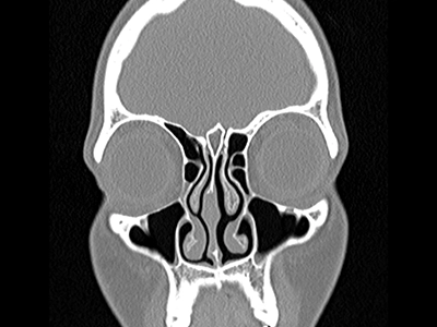 سی‌تی‌اسکن سینوس و بینی