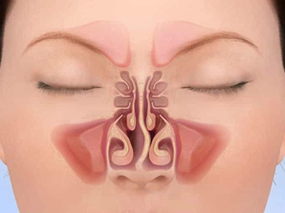 بهبود مسیر تنفسی با اصلاح تیغه بینی (سپتوپلاستی)