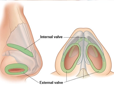 ترمیم دریچه‌های داخلی/خارجی بینی برای جلوگیری از کلاپس هنگام دم