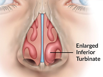 کاهش حجم شاخک‌های بینی برای عبور بهتر هوا