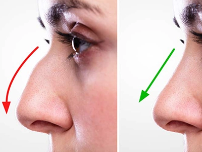 جراحی انحراف تیغه بینی (سپتوپلاستی)