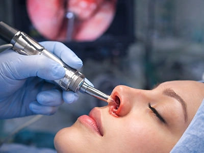 برداشتن پولیپ بینی و سینوس