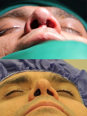جراحی ترمیمی بینی با غضروف دنده