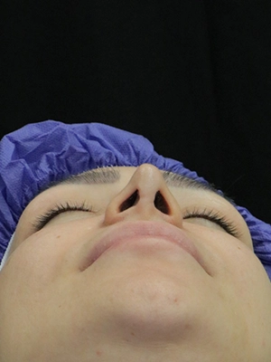 جراحی ترمیمی بینی با نتیجه طبیعی