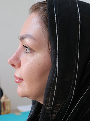 بازسازی بینی پس از جراحی ناموفق