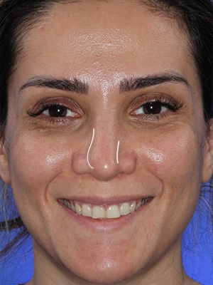 نتیجه جراحی ترمیمی بینی