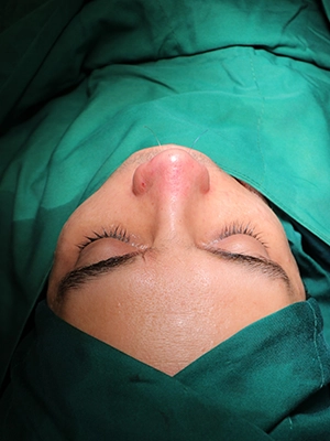 جراحی ترمیمی بینی با غضروف دنده