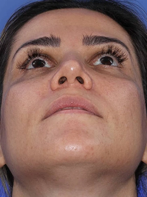 رضایت بیمار از جراحی ترمیمی بینی