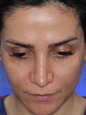 جراحی ترمیمی بینی با نتیجه موفق