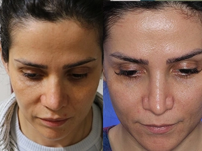 جراحی ترمیمی بینی