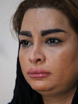 بدشکلی بینی پس از جراحی‌های ناموفق قبلی