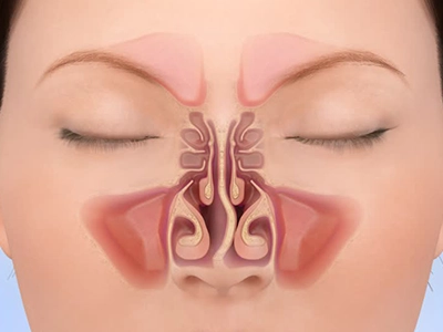 کاهش حجم شاخک‌های بینی