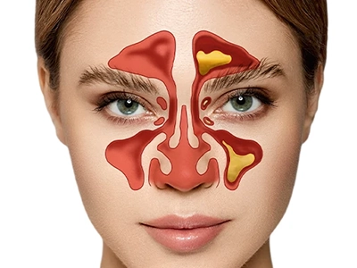 درمان گرفتگی مزمن بینی