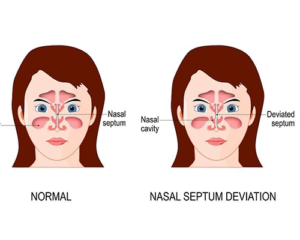 آیا انحراف بینی باعث سینوزیت می‌شود؟