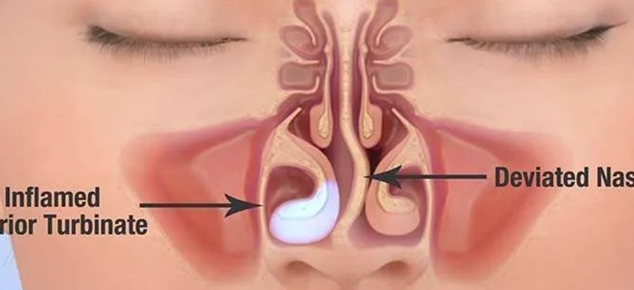 تاثیر انحراف بینی بر گوش، گلو و سردرد