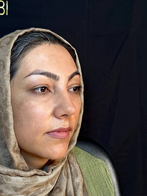 نمای سه رخ بعد از جراحی بینی استخوانی