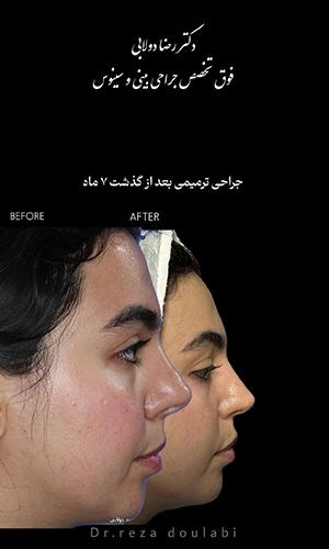 نمونه قبل و بعد جراحی ترمیمی بینی پس از ۷ ماه توسط دکتر دولابی