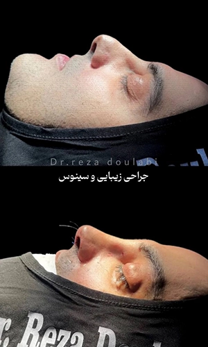 نمونه قبل و بعد جراحی بینی استخوانی و سینوس توسط دکتر دولابی