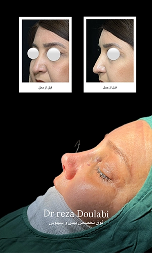 نمونه قبل و بعد جراحی بینی استخوانی با اصلاح قوز و فرم بینی توسط دکتر دولابی