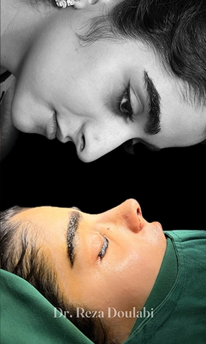 نمونه قبل و بعد جراحی بینی استخوانی با اصلاح قوز بینی توسط دکتر دولابی