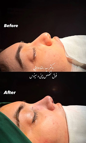 نمونه قبل و بعد جراحی بینی استخوانی از نمای نیمرخ توسط دکتر دولابی