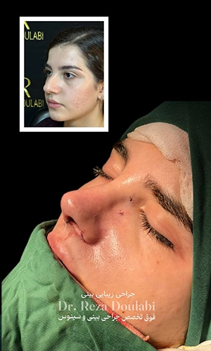 نمونه قبل و بلافاصله بعد از جراحی بینی استخوانی با اصلاح قوز بینی توسط دکتر دولابی