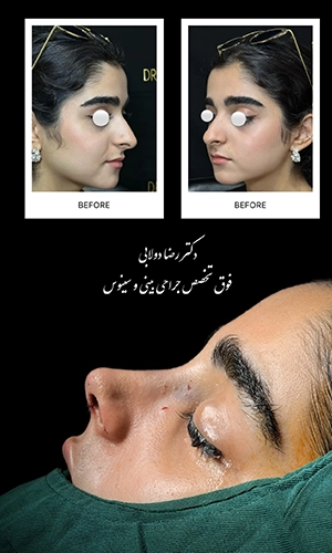 نمونه قبل و بلافاصله بعد از جراحی بینی استخوانی با اصلاح قوز و فرم نیمرخ توسط دکتر دولابی