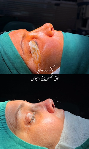 نمونه قبل و بلافاصله بعد از جراحی بینی استخوانی از نمای نیمرخ توسط دکتر دولابی